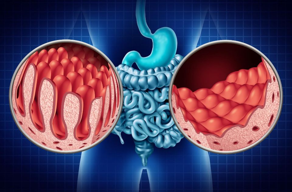 CMRA Celiac Disease