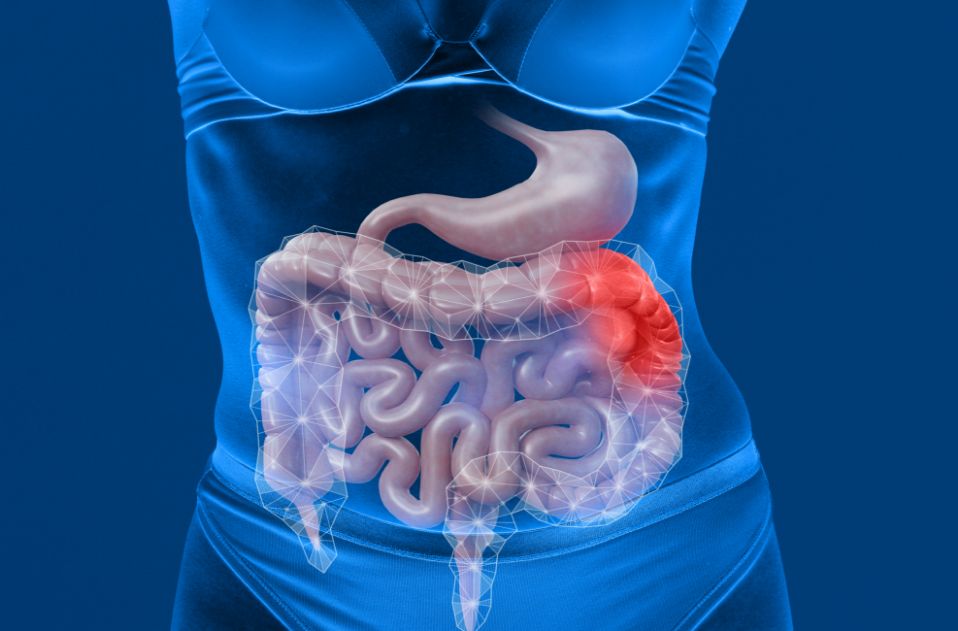 CMRA ULCERATIVE COLITIS